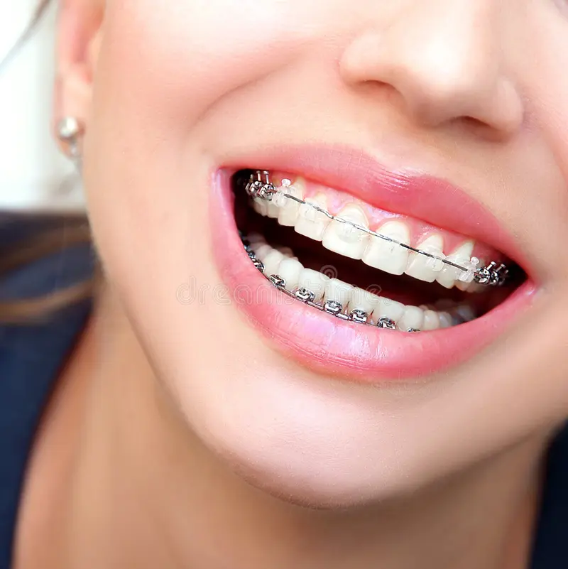 Braces