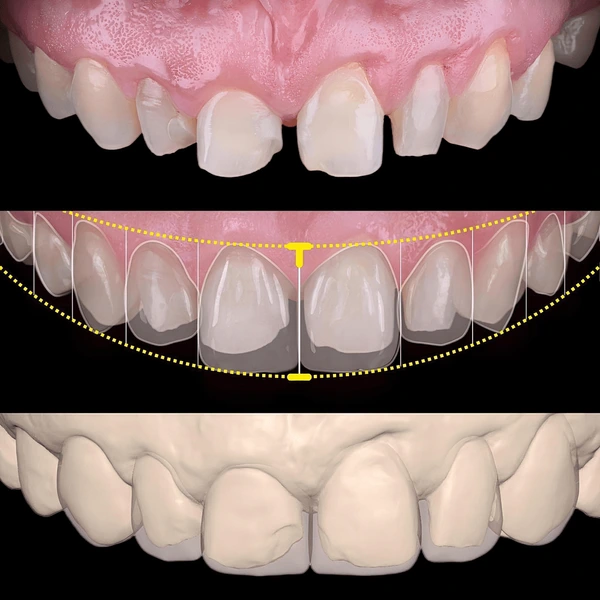 Smile Design / Digital Planning