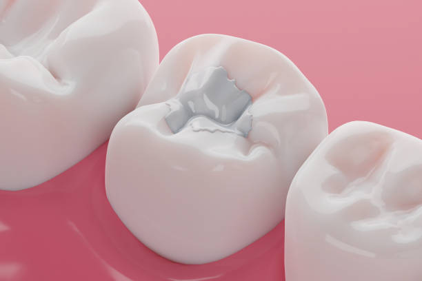 Tooth-Colored Fillings